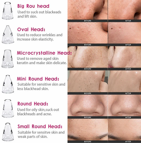 Premium Multi-Functional Black & Whitehead Remover For Pore & Pimples Cleaner Machine Men & Women